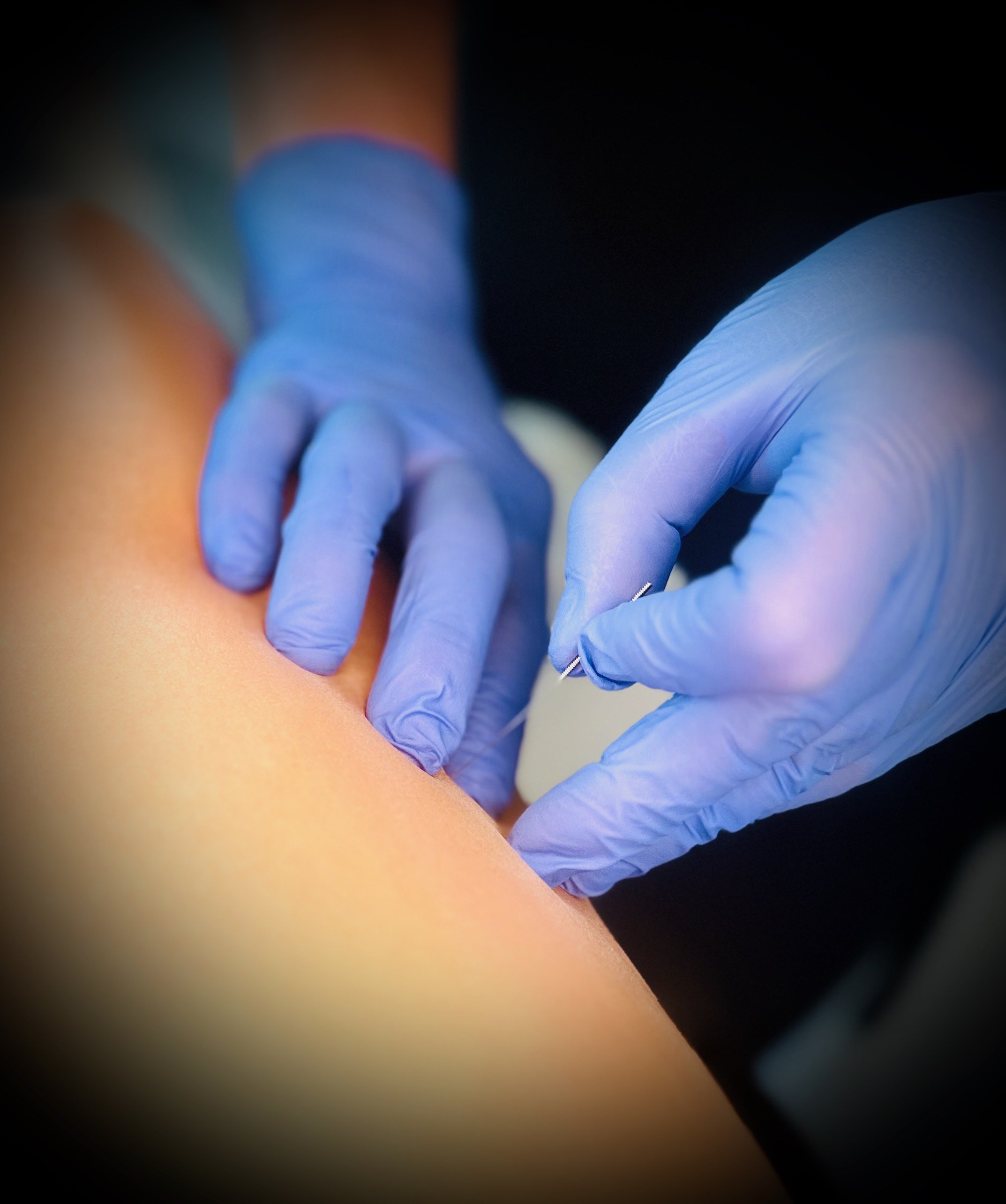 Foundations in Dry Needling