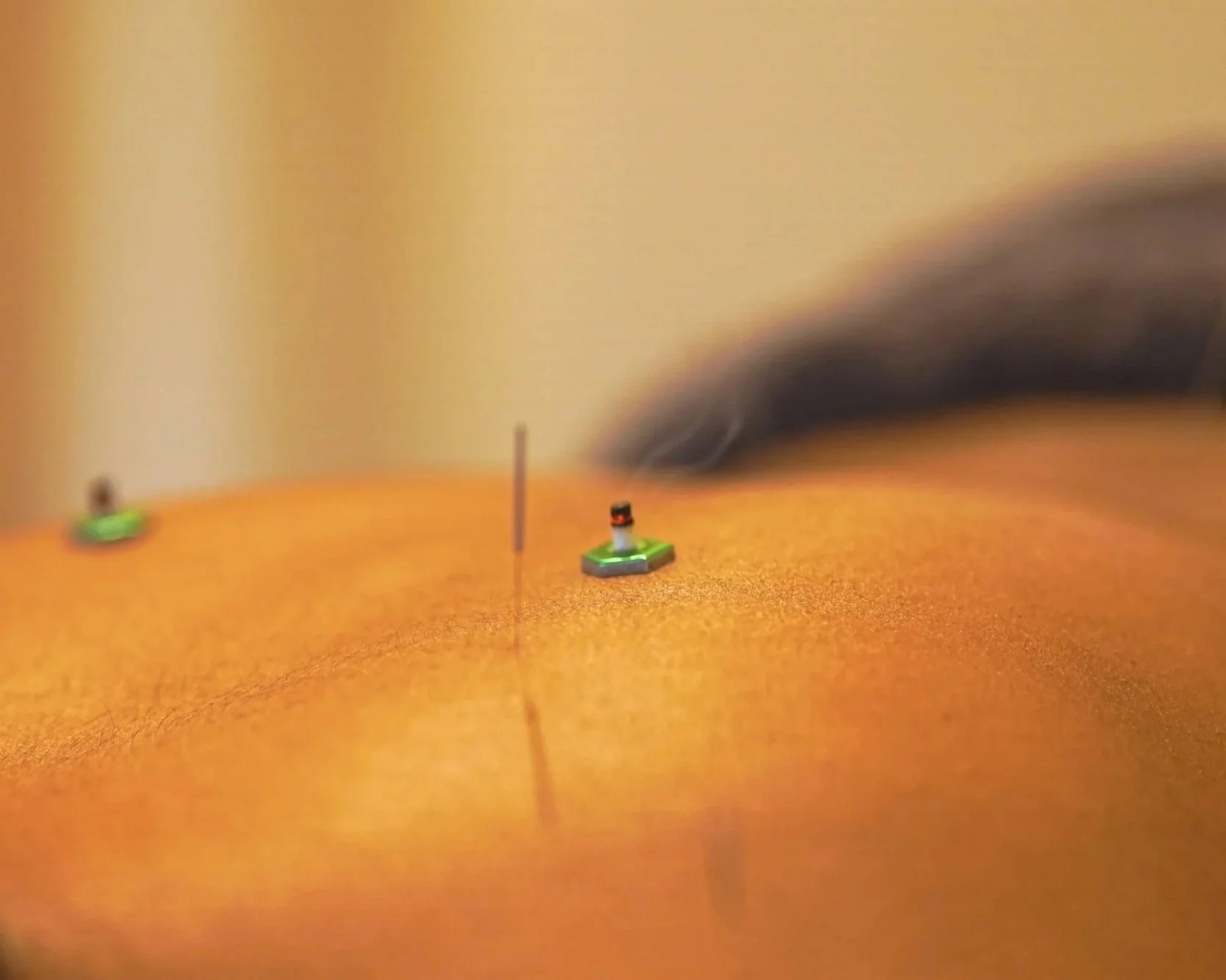 What is Moxibustion?