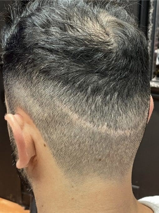 Scarring Treatment (FUT)
