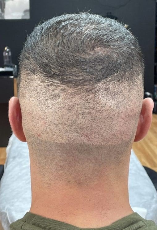 Scarring Treatment (FUE)
