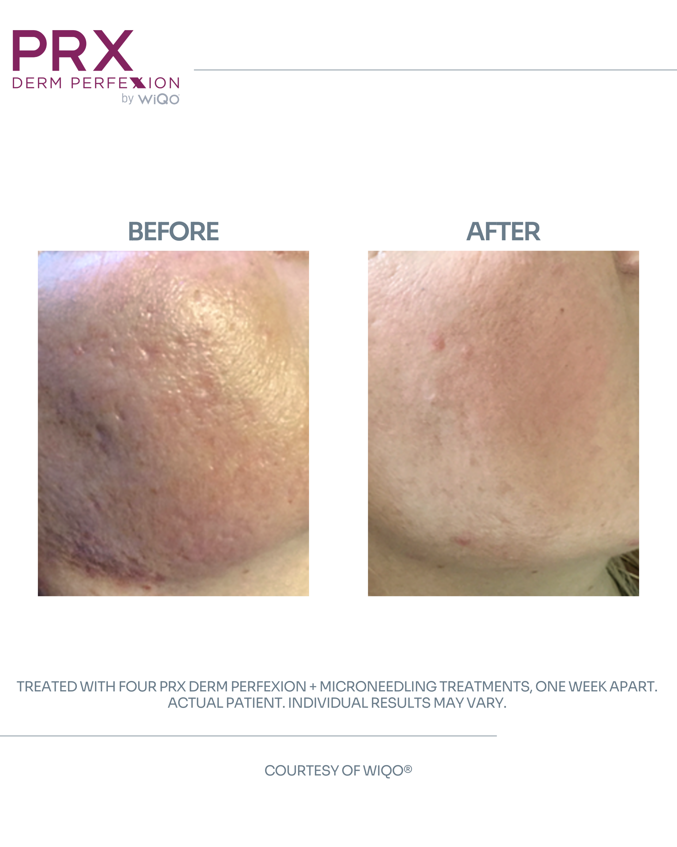 Actual Patient #5 - DETAILS_ 4 PRX Derm Perfexion + Microneedling Treatments.png