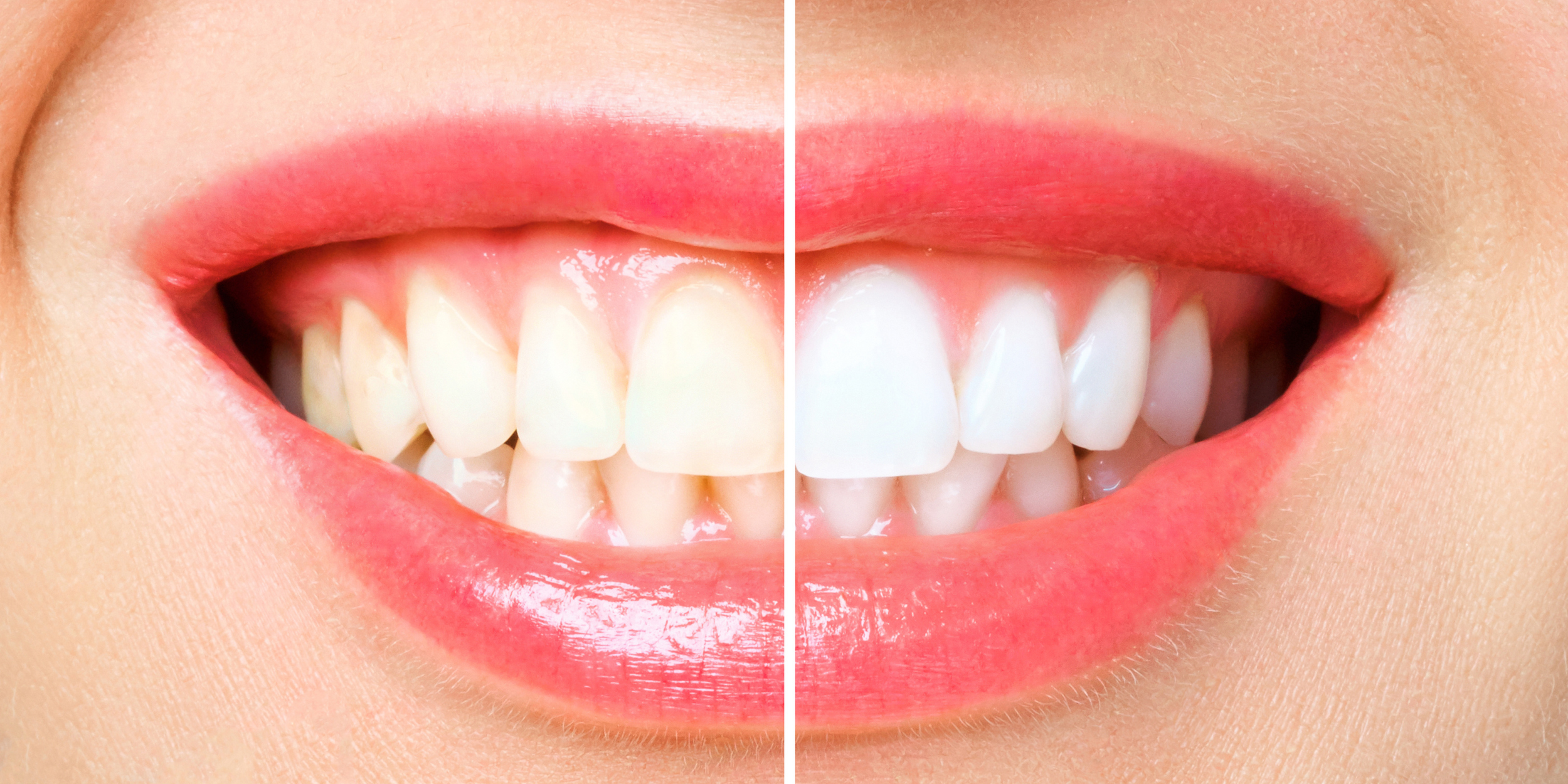 teeth whitening before and after