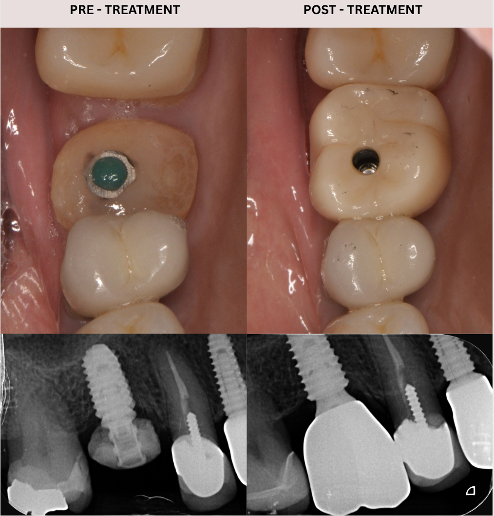 CASE 1