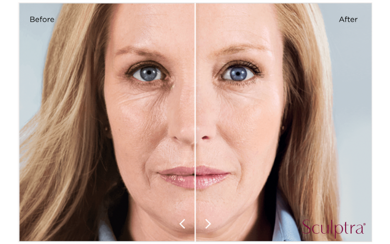Before and After Sculptra Injections