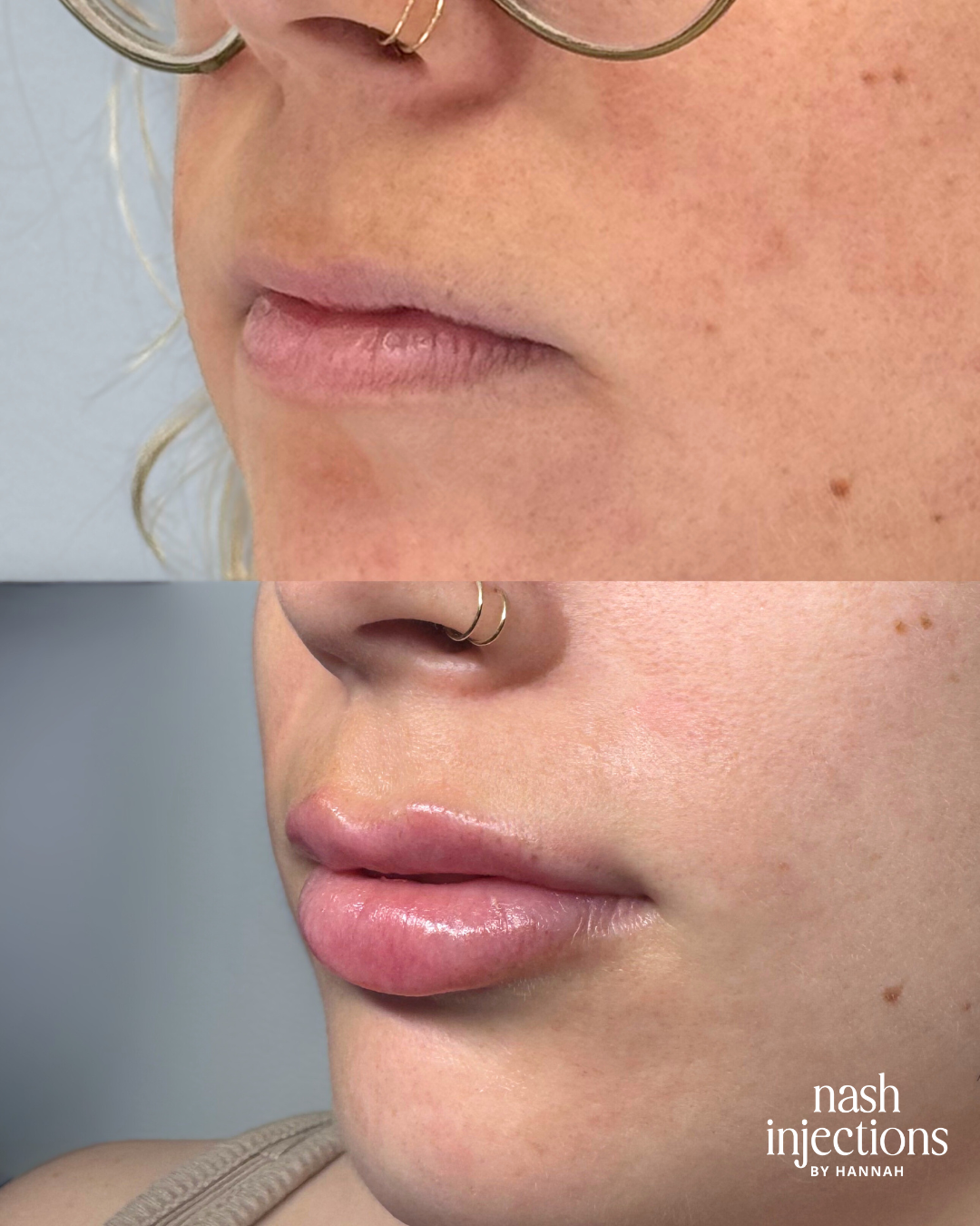 Before and After Lip Filler in Nashville