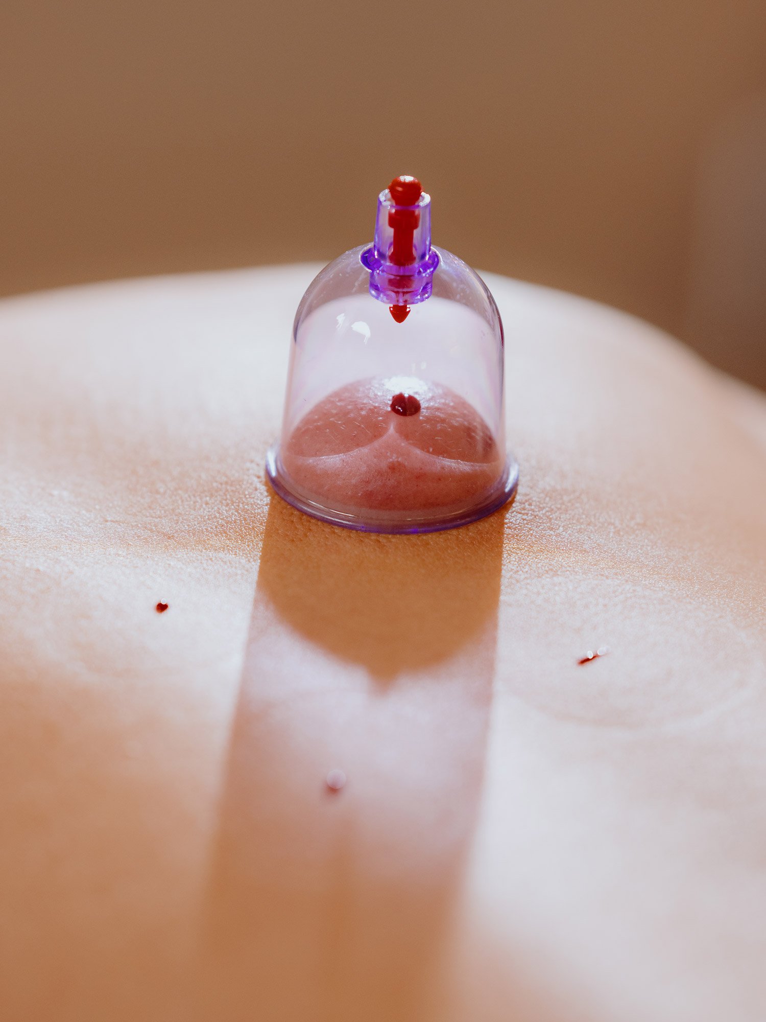 Friendly Acupuncture Clinic: Acupuncture & East Asian Bodywork in Ballard, Seattle WA