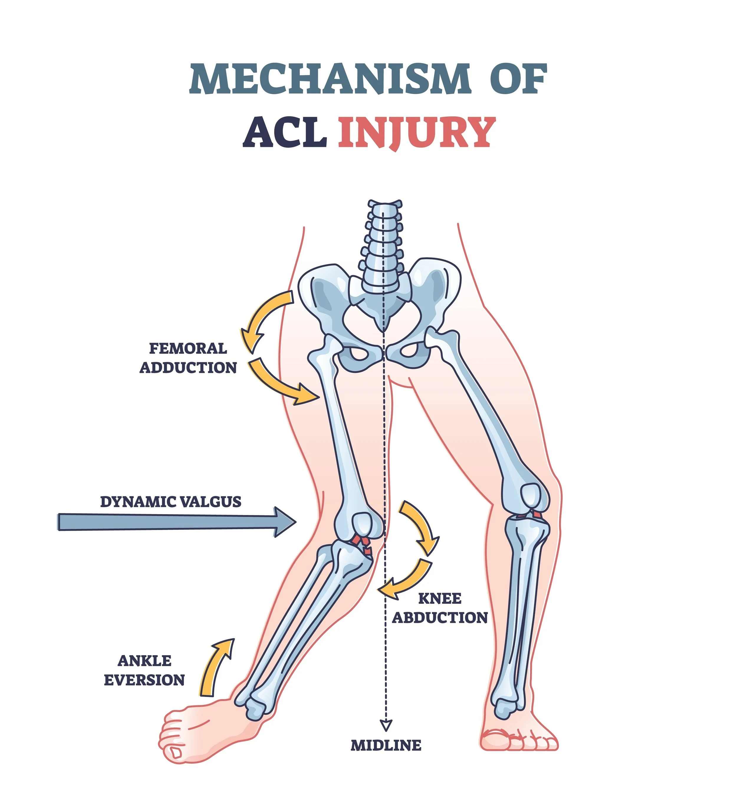 Diagram of a horse's pelvis and leg indicating the mechanism of ACL injury, showing the femoral conduction, dynamic valgus, knee abduction, ankle eversion, and midline.