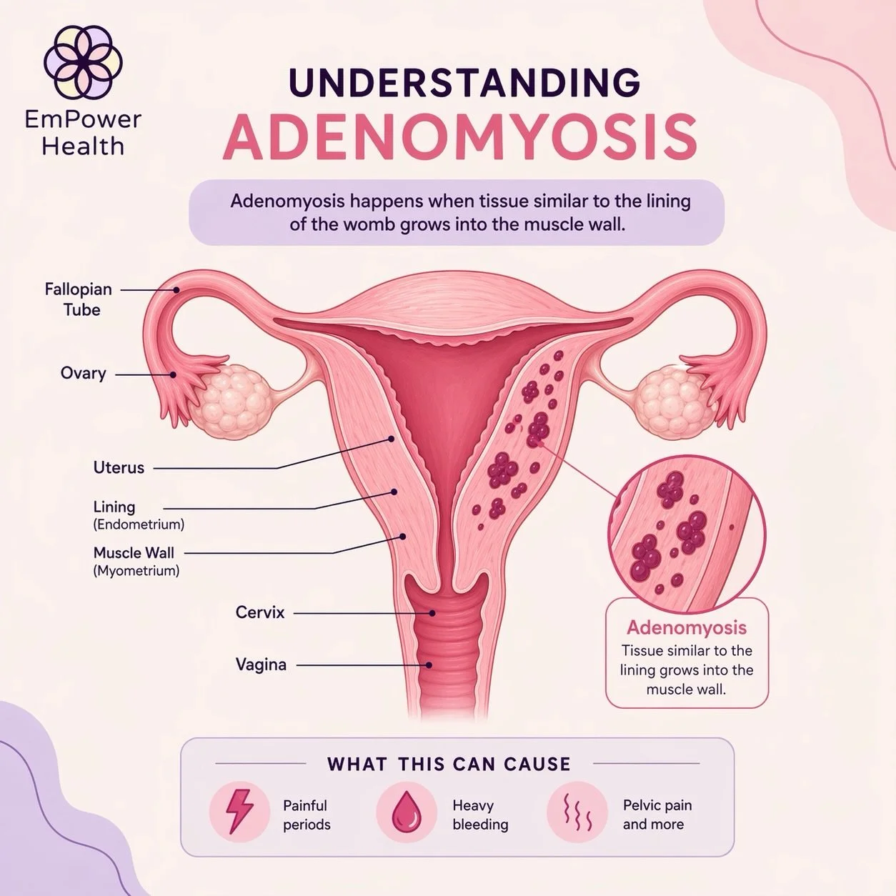 🩸 You might think heavy &amp; painful periods are common&hellip; but that does NOT make them NORMAL. ❌ (Read that again!) 

🩷💛April is Adenomyosis Awareness Month 💛🩷

Adenomyosis is a condition where tissue similar to the lining of the womb grow