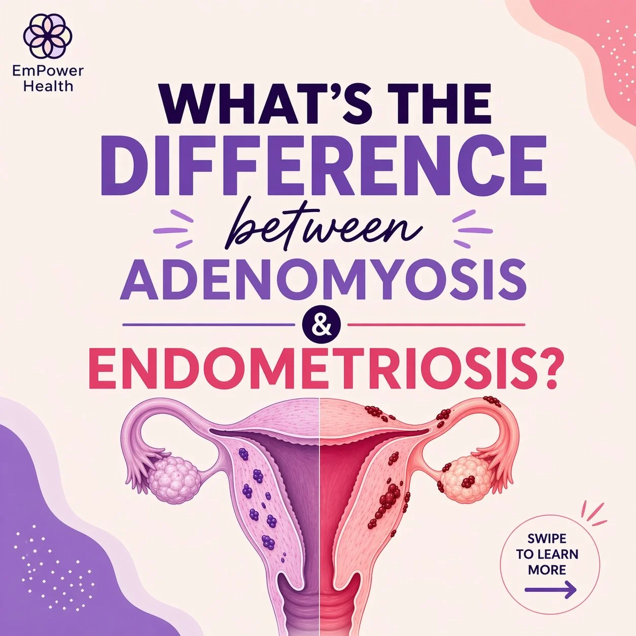 ❓Do YOU know the difference between Adenomyosis and Endometriosis❓➡️➡️ swipe to educate yourself 🫶🏻

#empowerhealth #adenomyosis #endometriosis #womenshealth #womenshealtheducation