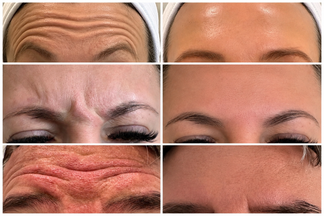 Six close-up images showing the forehead and eye area of a person's face before and after skincare treatment, highlighting reduction of wrinkles and improved skin appearance.