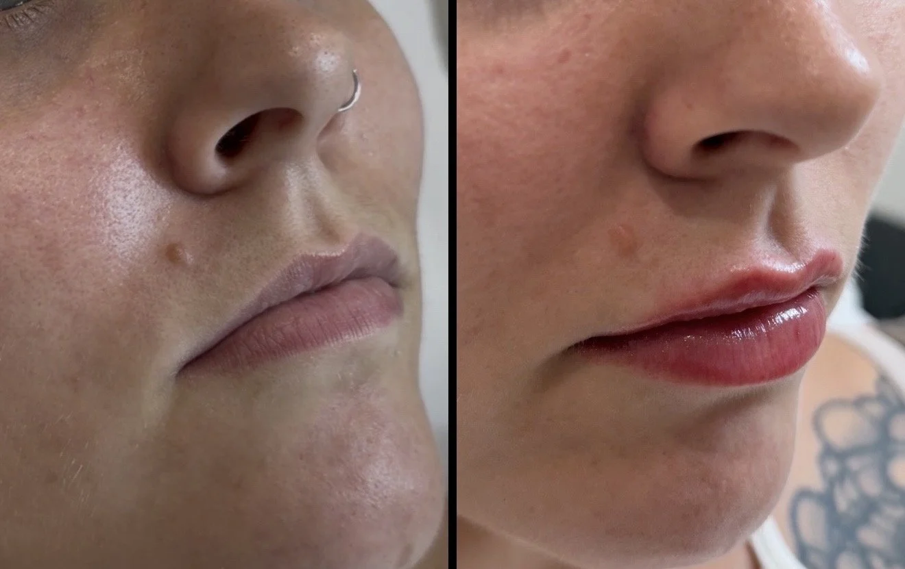 Close-up of two women, the image shows a side-by-side comparison of their lips and noses. The woman on the left has natural lips and a nose with a septum piercing, while the woman on the right has fuller, glossy lips with a tattoo visible on her shoulder.