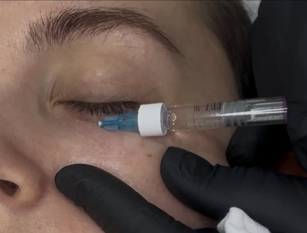 A person receiving an injection near the lower eyelid while lying down, with a gloved hand holding the syringe.