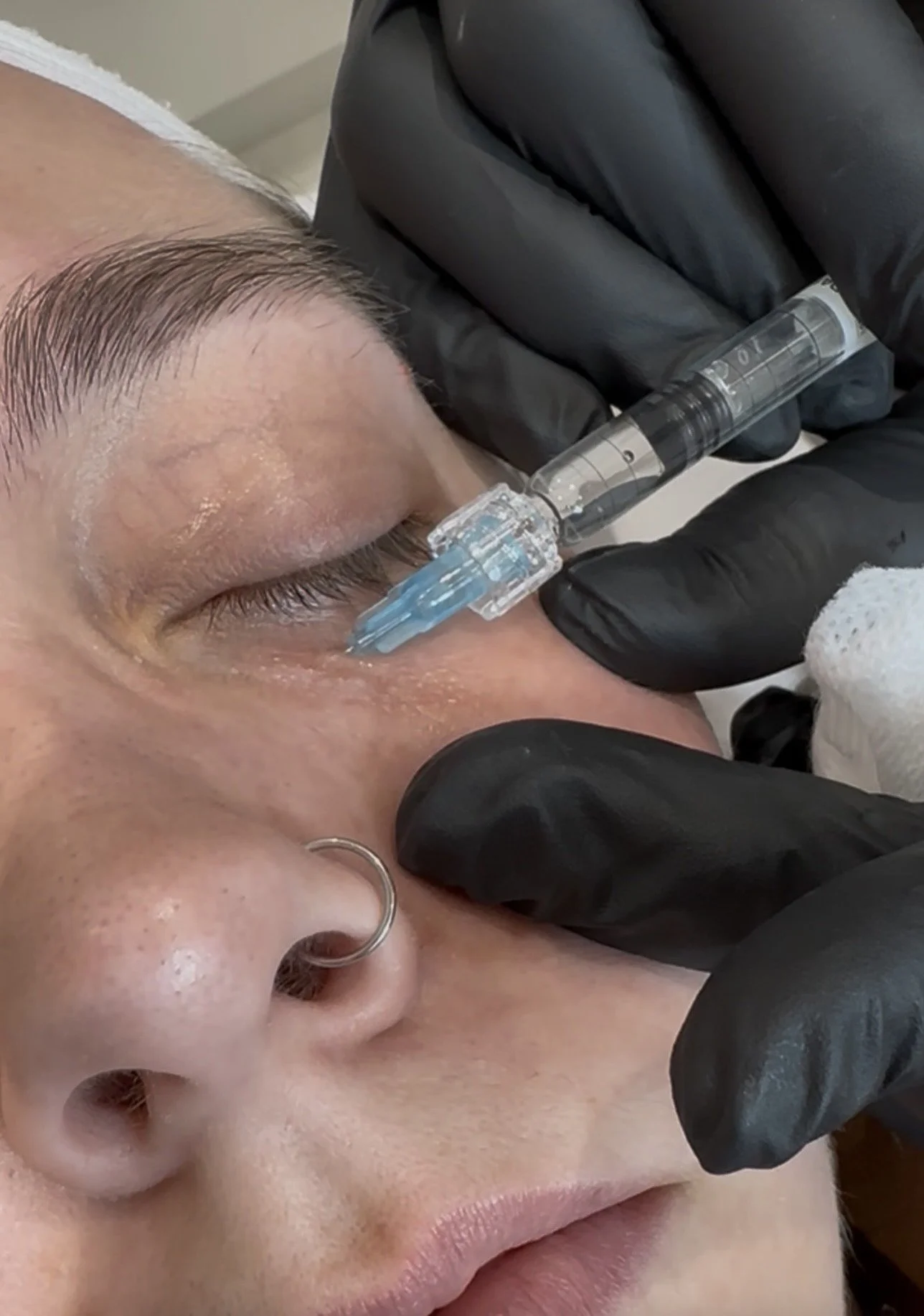 A person receiving a cosmetic injection near the eye from a professional wearing black gloves.