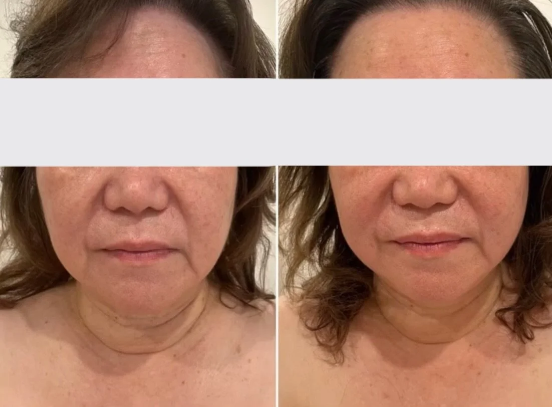 Sometimes I can feel the exact moment the muscles begin to soften beneath my hands. That&rsquo;s when I sense the person is beginning to feel safe enough to let go.

In this before and after, you can see less puffiness, a little more definition throu