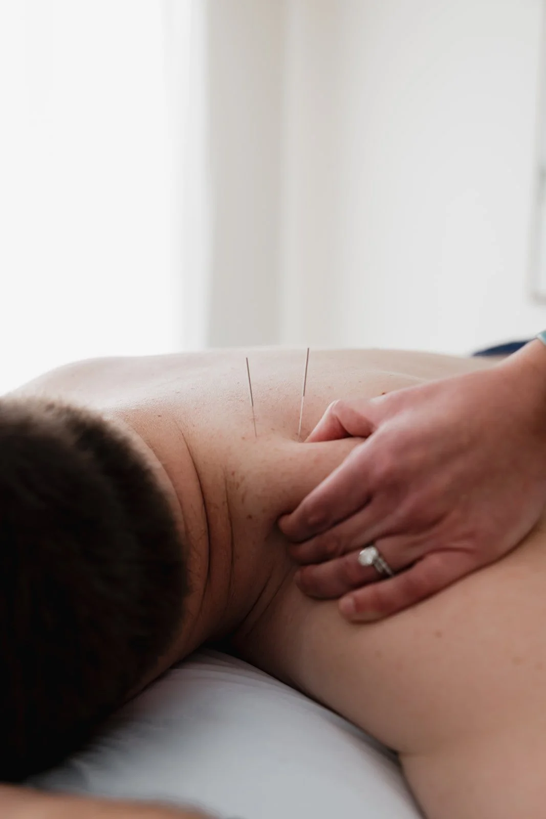 Man getting dry needling in shoulder during physical therapy in Columbia, MO