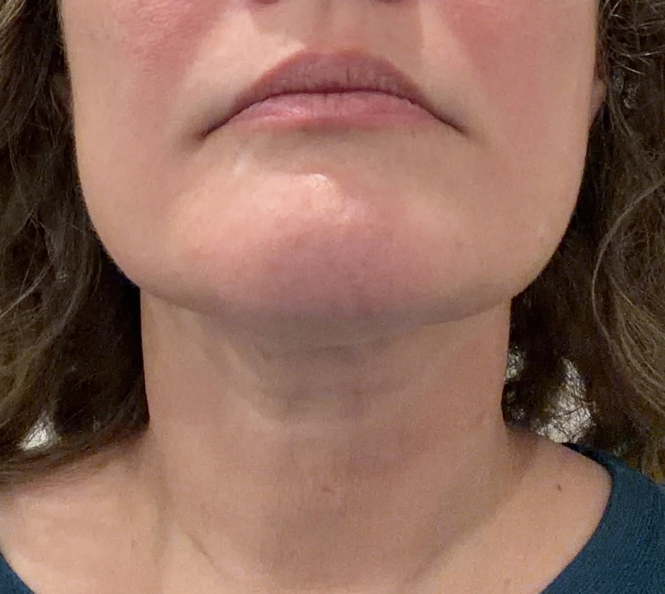 After - platysmal bands Botox