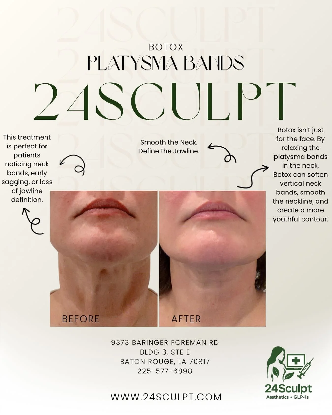 Those vertical lines you see in the before photo aren&rsquo;t wrinkles &mdash; they&rsquo;re platysma bands (muscles).

When those muscles tighten with age, they pull the neck downward and create visible bands.

💉 Botox relaxes those muscles, allowi