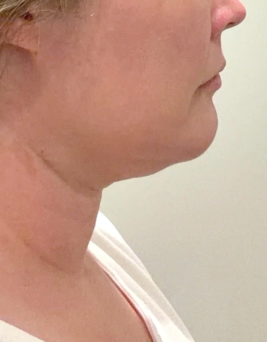 Before - platysmal bands Botox