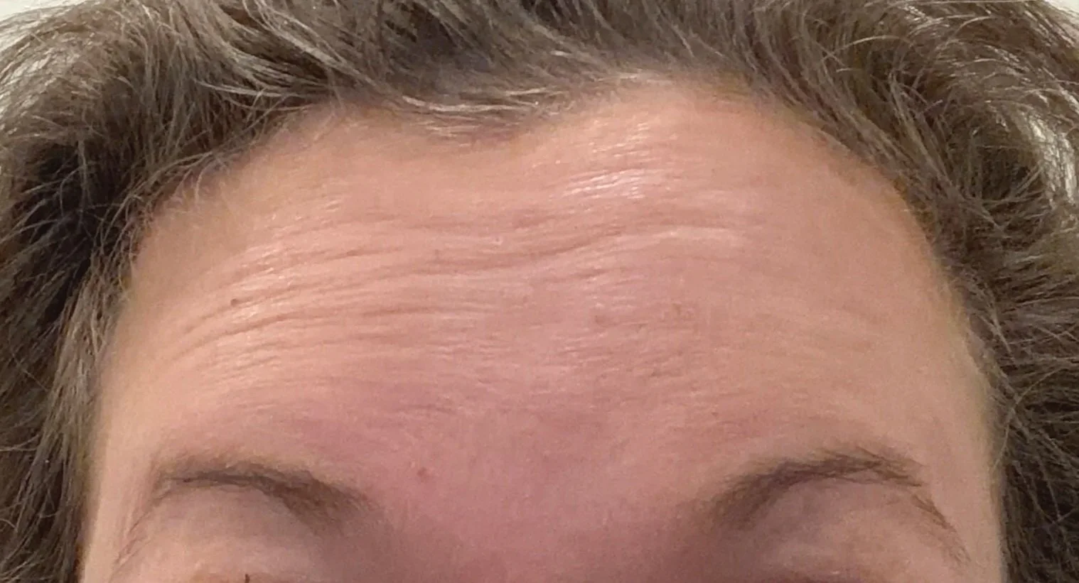 Before - forehead wrinkles Botox