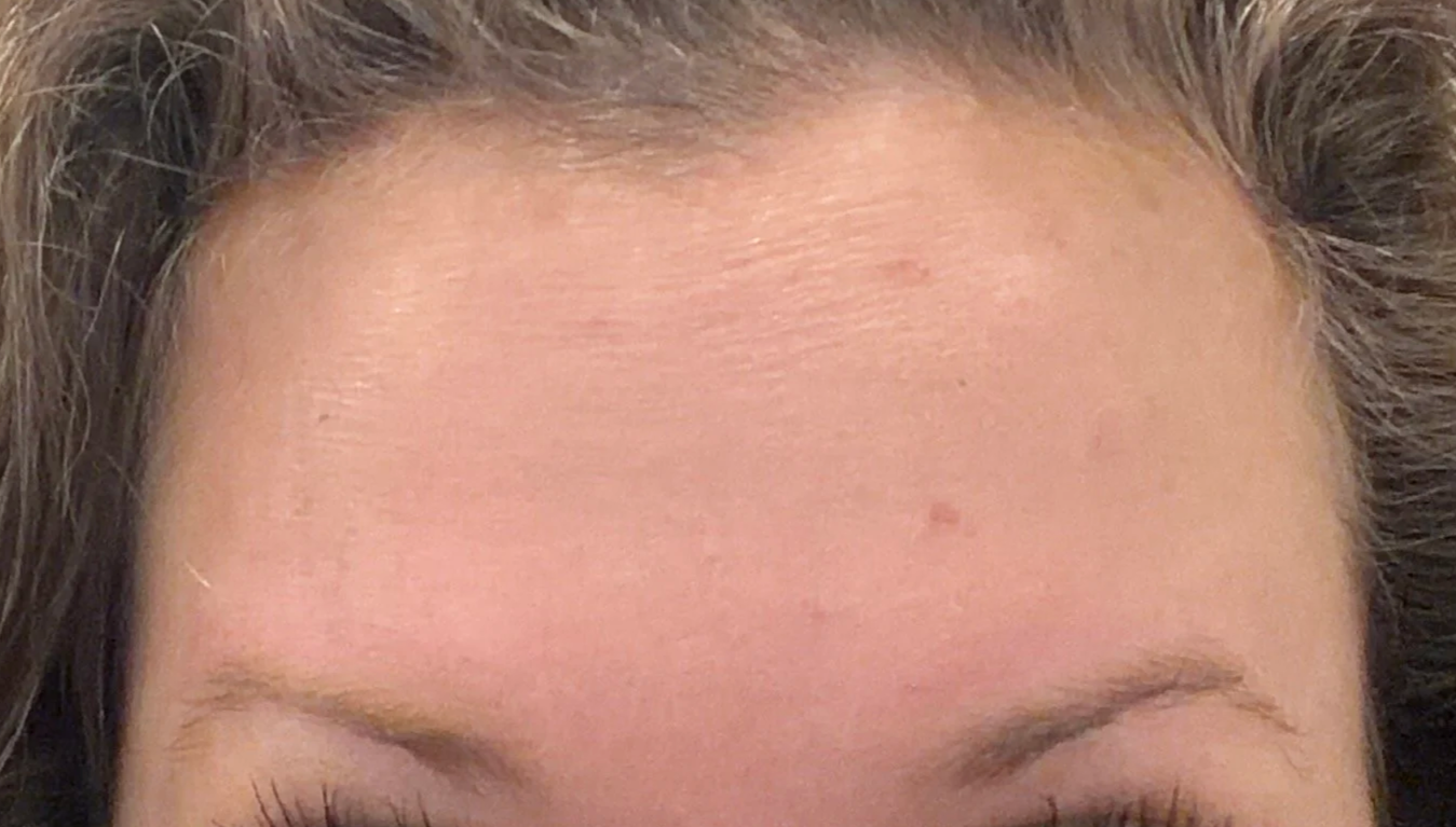 After - forehead wrinkles Botox