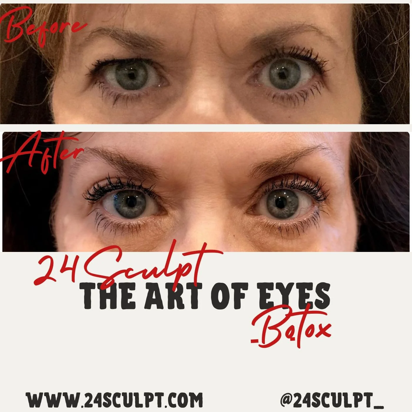 Subtle lift. Softer lines. Improved ptosis. Brighter eyes.

This is the power of precision ✨
A refreshed, natural look&mdash;never frozen, never overdone.

At 24Sculpt, it&rsquo;s not just Botox&hellip; it&rsquo;s artistry.

Ready to open up your eye