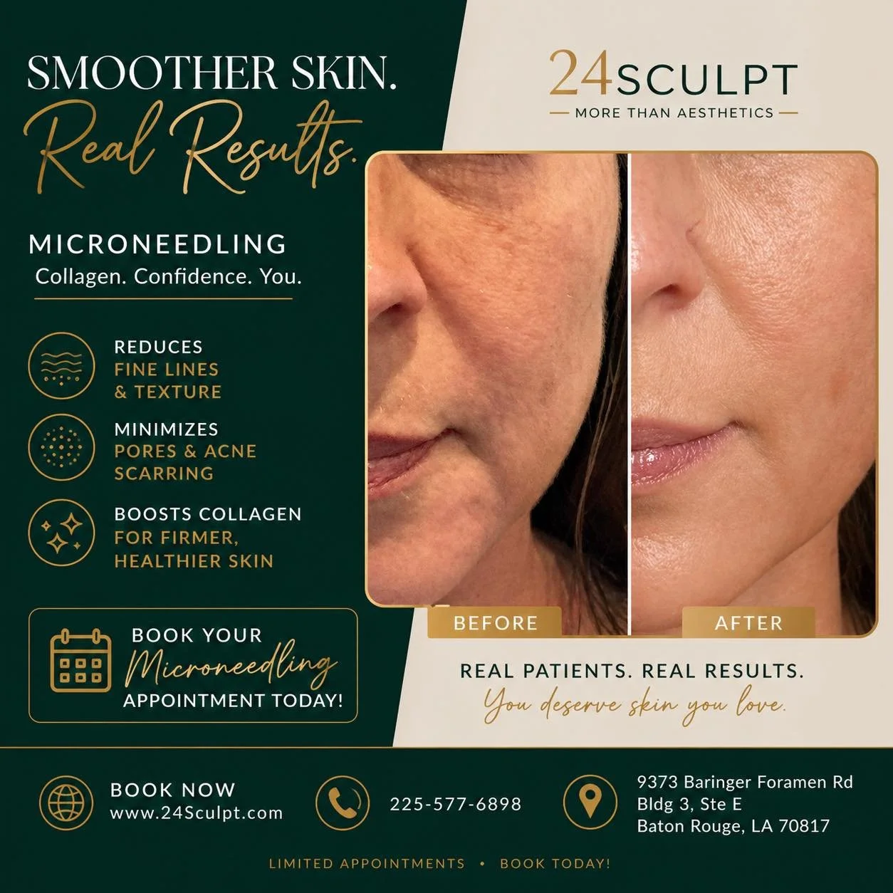 Microneedling is one of the best ways to improve texture, fine lines, and overall skin quality&mdash;and these results speak for themselves 👀

💉 Boost collagen
✨ Smooth uneven texture
🧖&zwj;♀️ Minimize pores + acne scarring

Real patients. Real gl