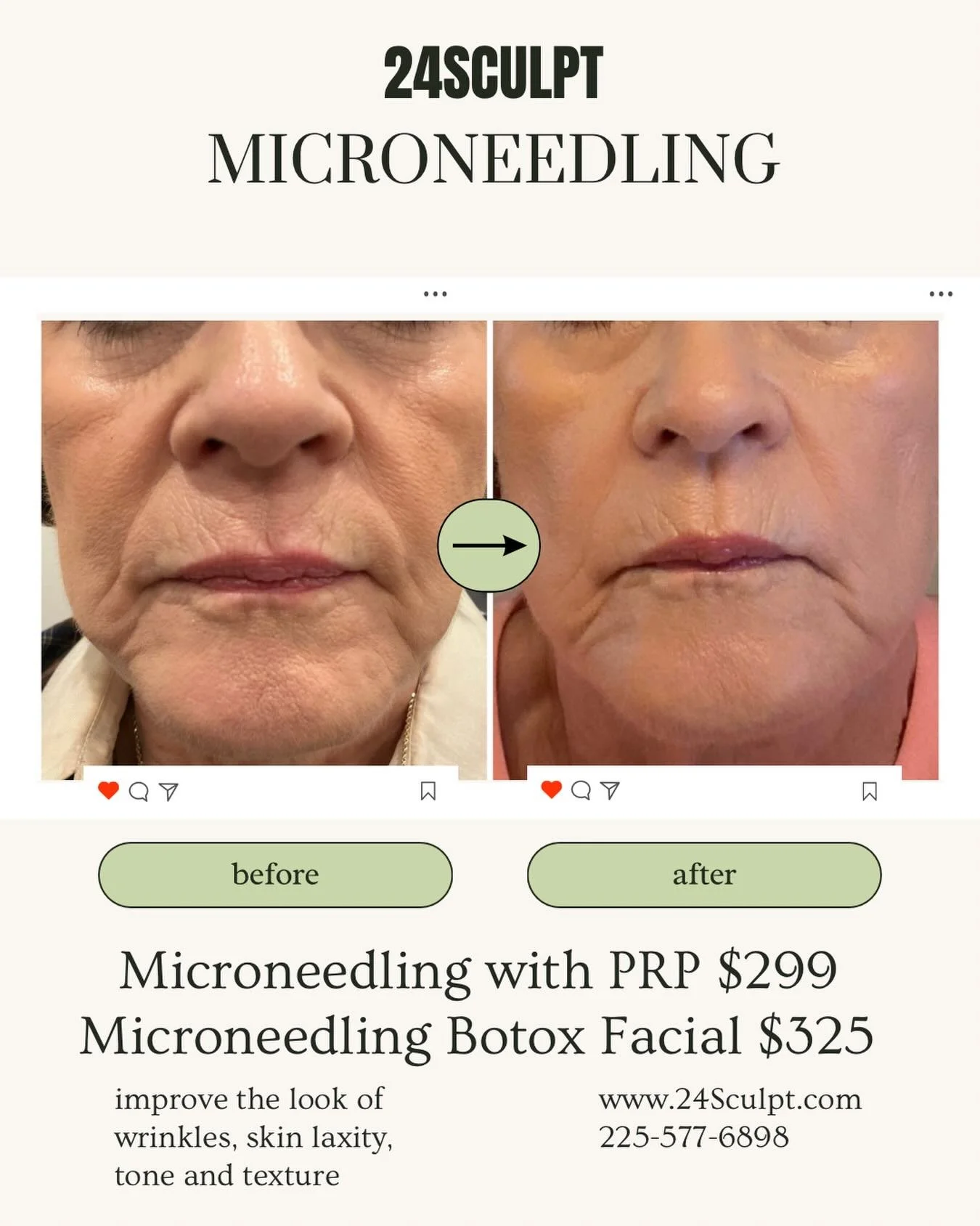 ✨ Smooth. Tighten. Refresh. ✨

Real results with microneedling at 24Sculpt 💚

Our treatments help improve:
&bull; Fine lines &amp; wrinkles
&bull; Skin texture
&bull; Skin laxity
&bull; Overall tone &amp; glow

✨ Microneedling with PRP &mdash; $299
