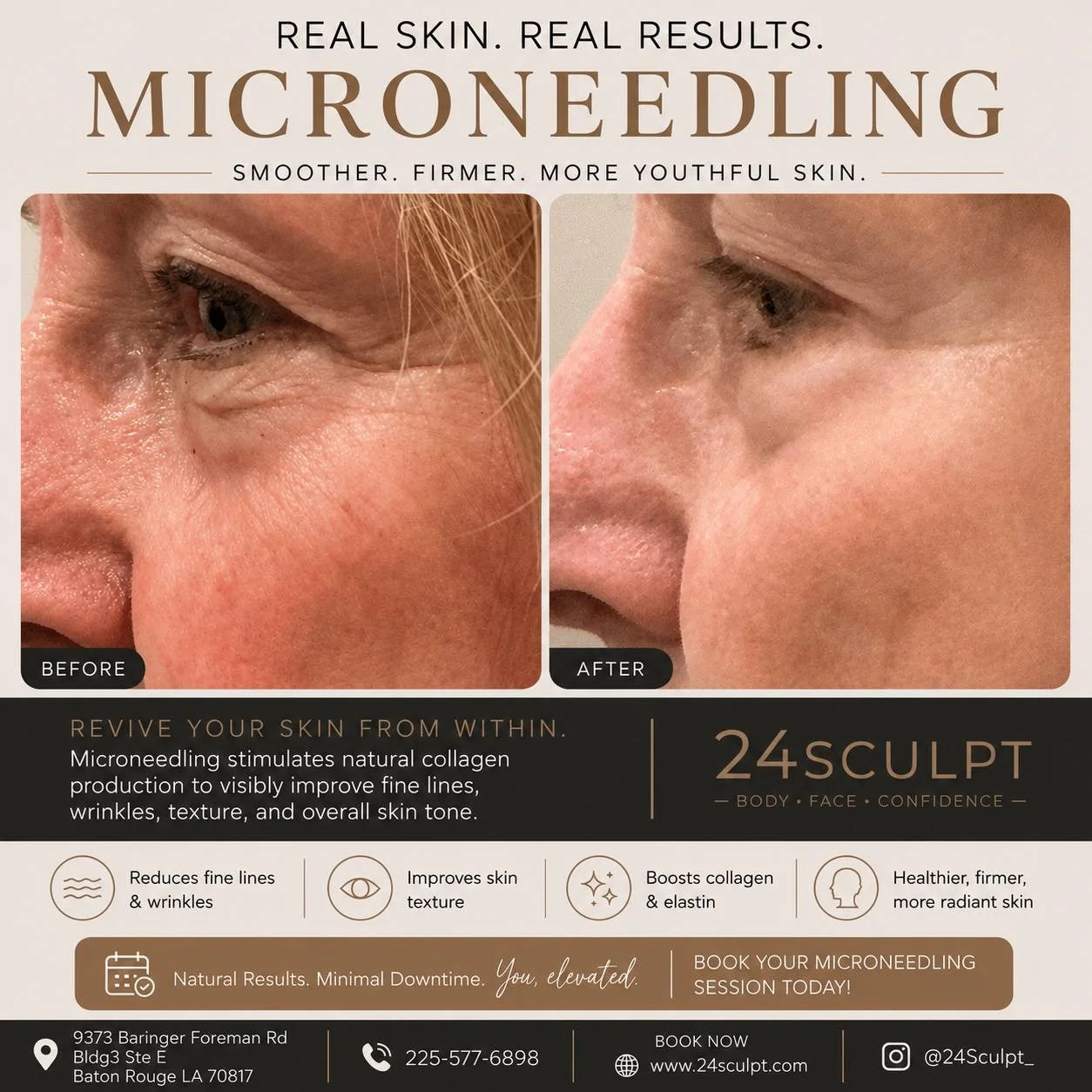 ✨ REAL RESULTS. REAL CONFIDENCE. ✨

Fine lines, crepey skin around the eyes, uneven texture, and loss of firmness don&rsquo;t have to define your skin.

Microneedling stimulates your body&rsquo;s natural collagen and elastin production to help improv
