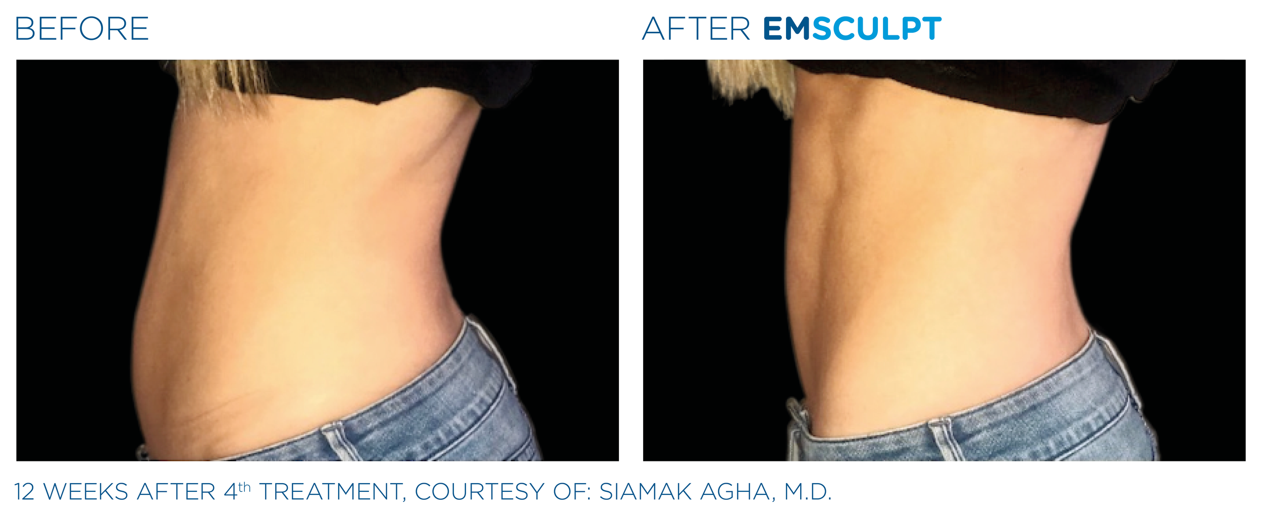 EMSCULPT-BEFORE-AFTER-ABS-FEMALE-BARE-ENVY-LASER-REGINA.jpg (Copy)