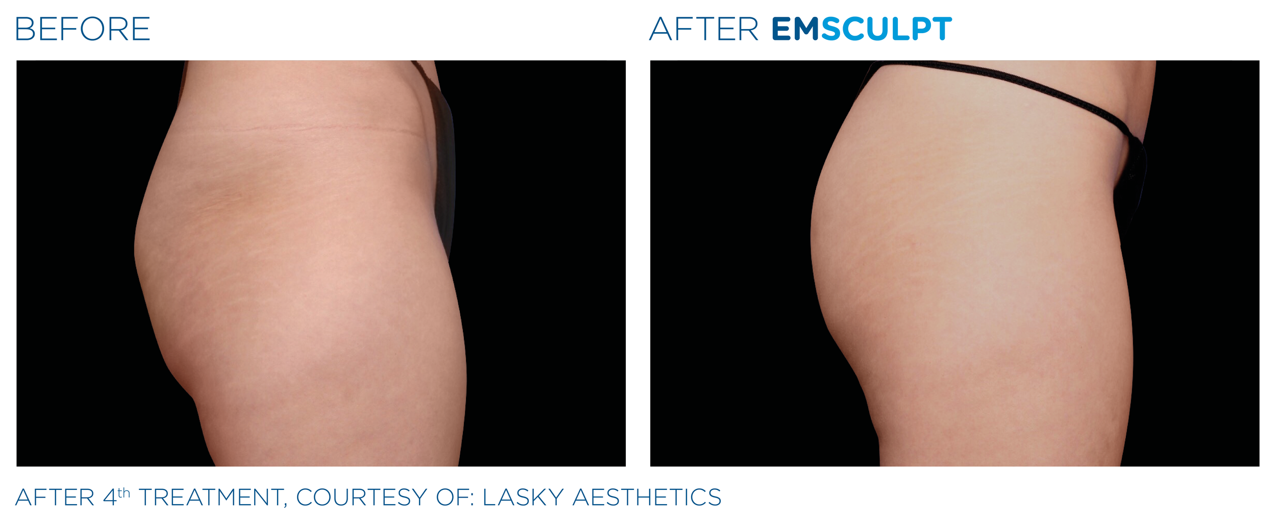Before and after- glutes Emsculpt.jpg
