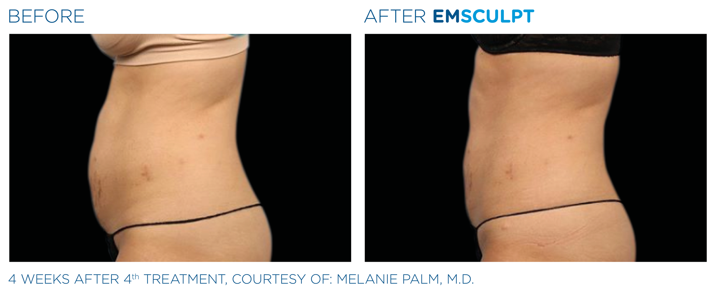 Before and after- Abdomen Emsclupt.jpg