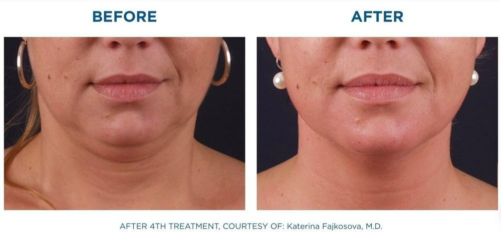 Neck before and after BTL Exilis Elite