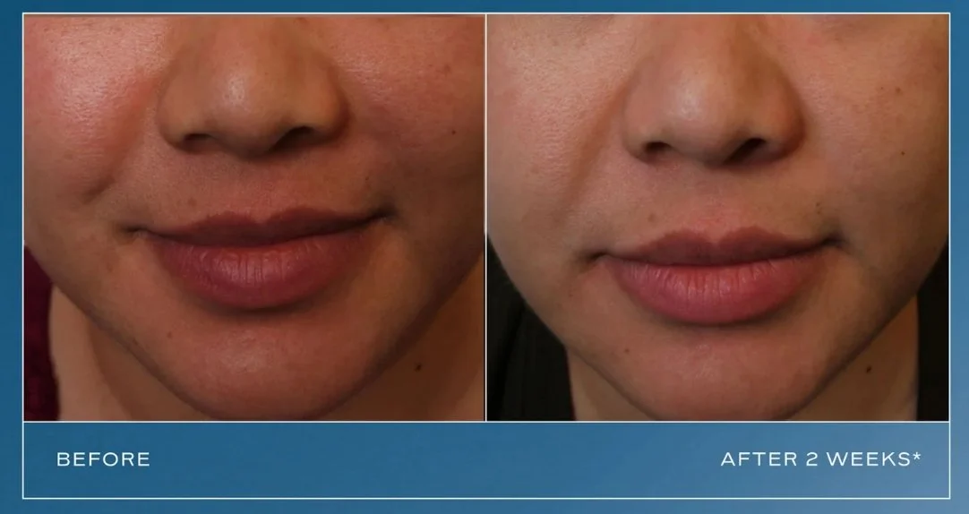 iS clinical-2 weeks before and after.jpeg