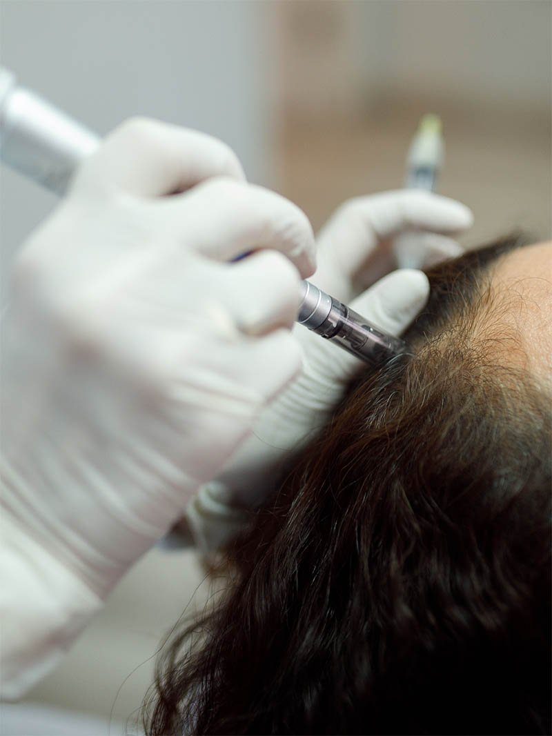 Hair Treatment with Microneedling