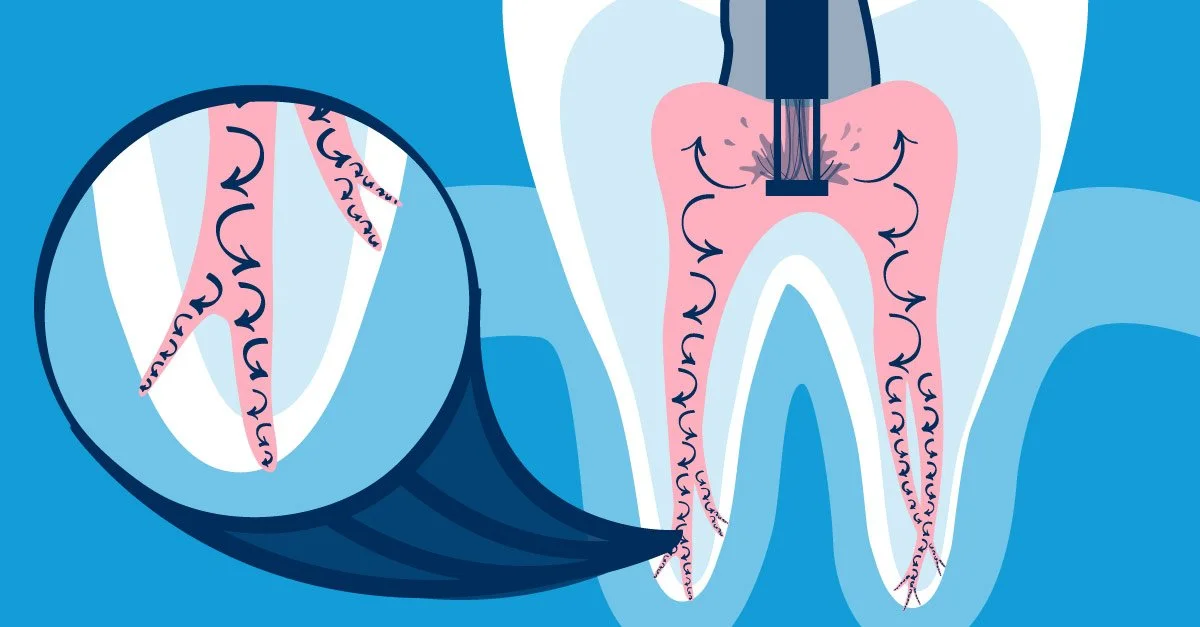 GentleWave® root canal in Fort Worth: Is the new technology worth it?