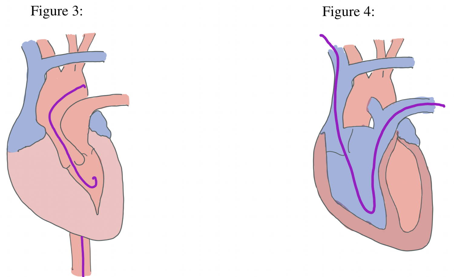 Right Heart Catheterization vs. Left Heart Catheterization vs. Coronary ...
