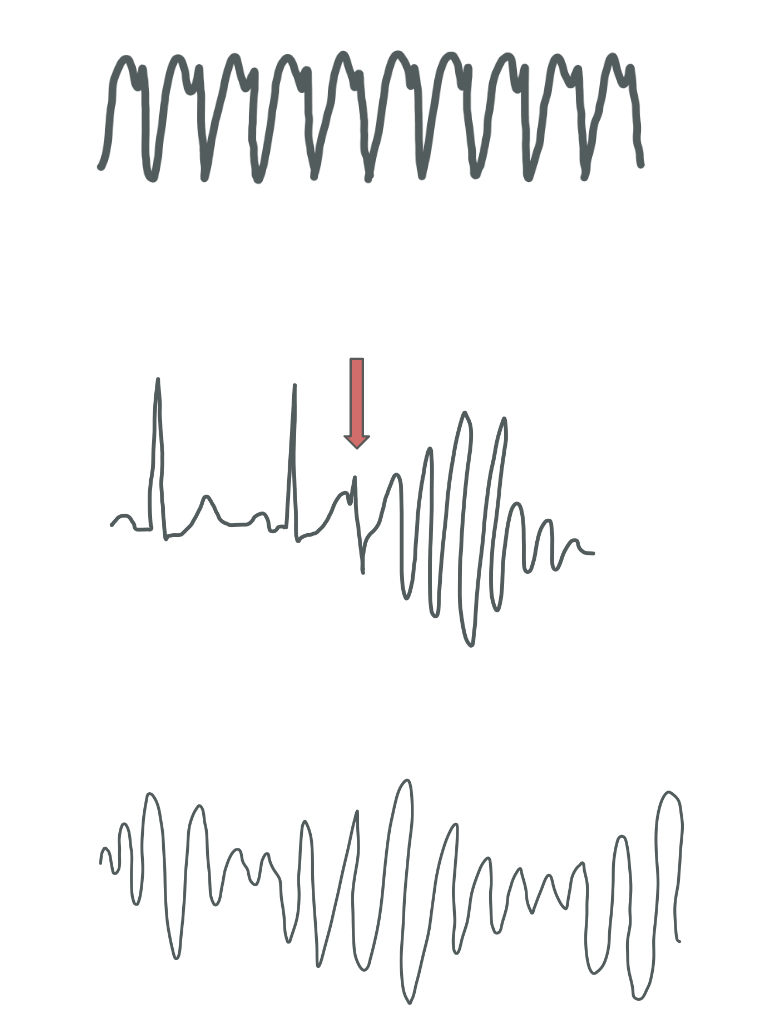 Wide Complex Vt Wide Complex Tachycardia — When the Beat Drops: A Resident's Guide to ...