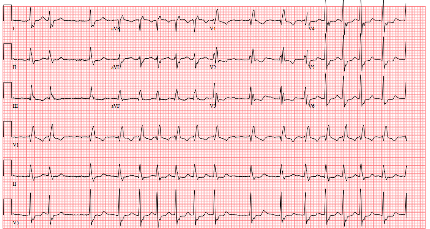 Tetralogy of Fallot — When the Beat Drops: A Resident's Guide to the CCU