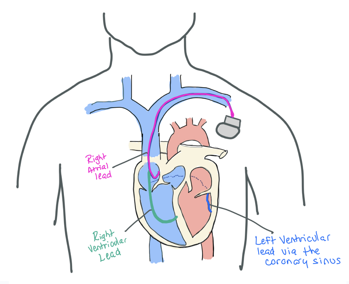 Lbbb Pacemaker Risks Pacemakers and ICDs — When the Beat Drops: A Resident's Guide to the CCU