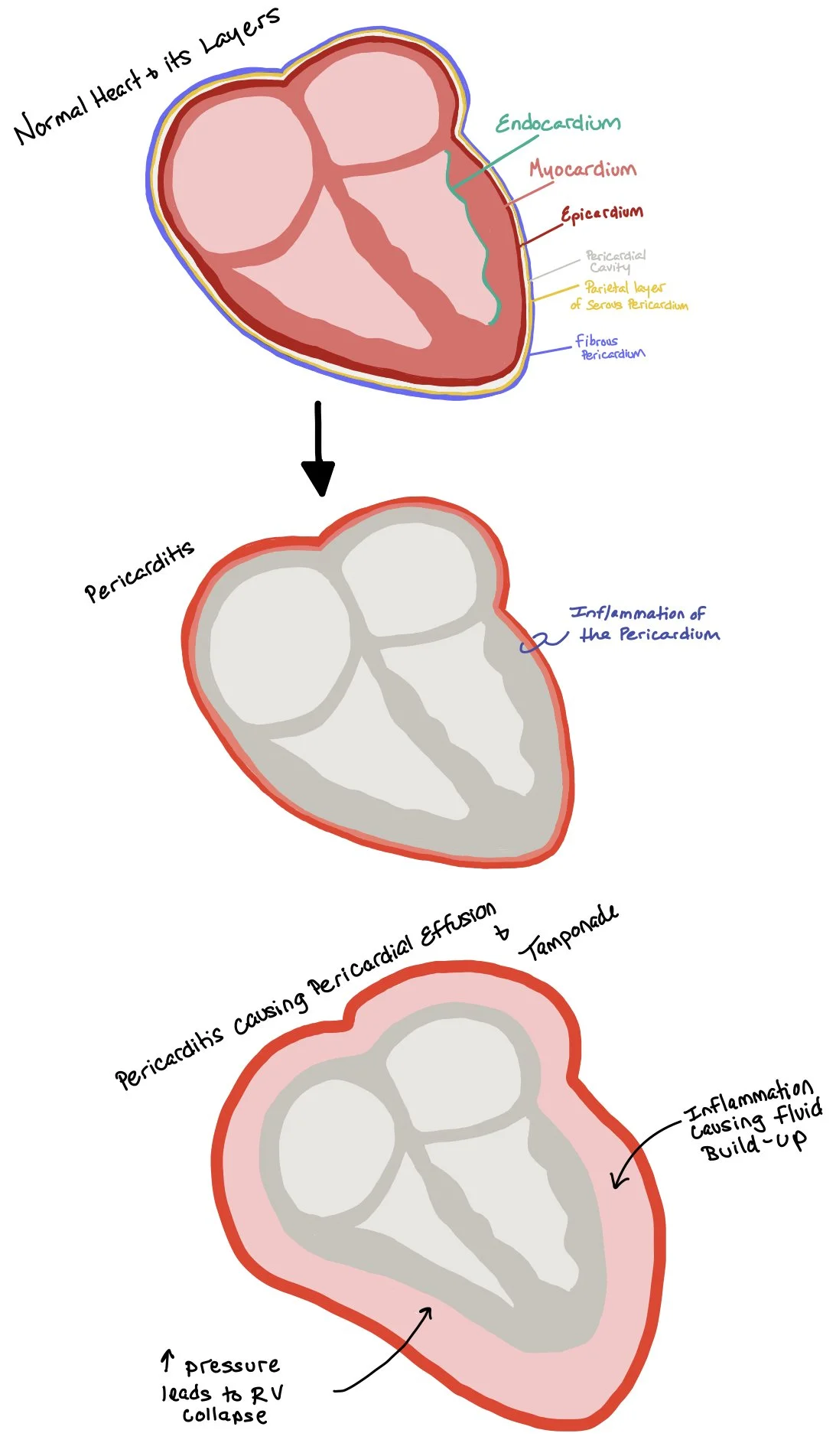 Myocardial Infarction (MI) Complications — When the Beat Drops: A ...