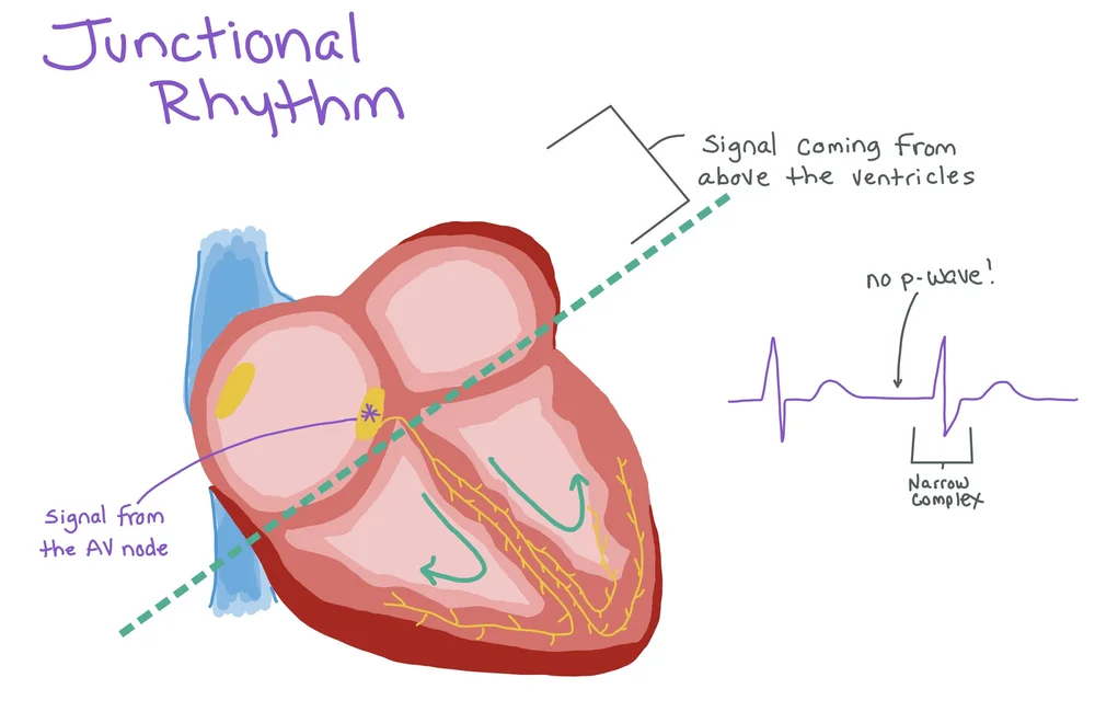Bradycardia — When the Beat Drops: A Resident's Guide to the CCU