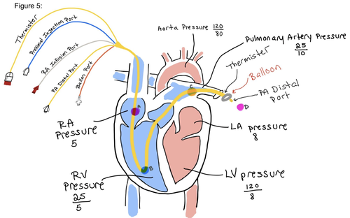 Thermodilution Sensor Pulmonary Artery Catheters / Swans — When the Beat Drops: A Resident's ...