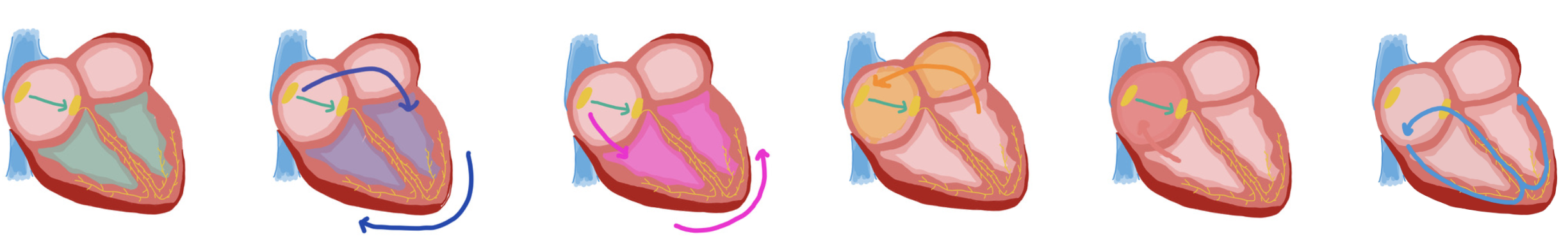 SVT: AVRT vs AVRNT — When the Beat Drops: A Resident's Guide to the CCU