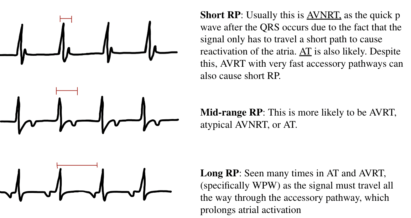 SVT: AVRT vs AVRNT — When the Beat Drops: A Resident's Guide to the CCU