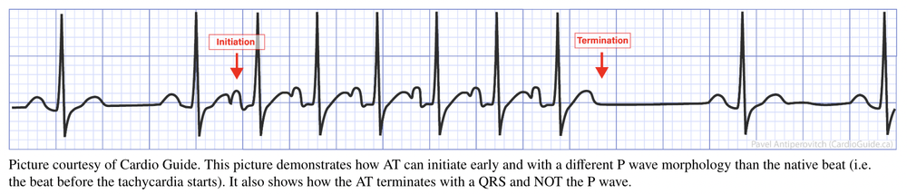 SVT: AVRT vs AVRNT — When the Beat Drops: A Resident's Guide to the CCU