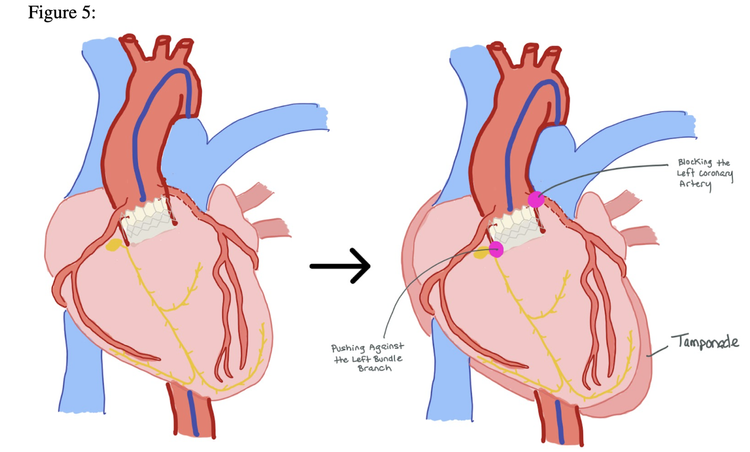 Tavr Algorithm TAVR Complications — When the Beat Drops: A Resident's Guide to the CCU