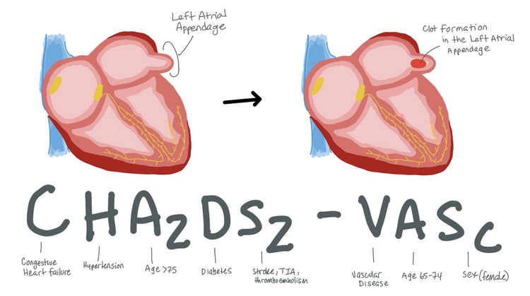 Atrial Fibrillation (AF) — When the Beat Drops: A Resident's Guide to ...
