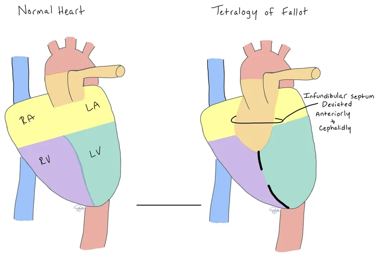 Tetralogy of Fallot — When the Beat Drops: A Resident's Guide to the CCU