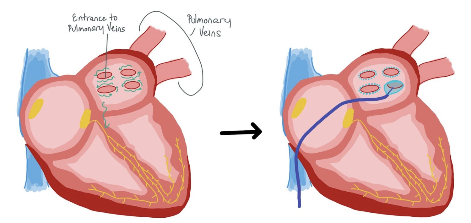 Atrial Fibrillation (AF) — When the Beat Drops: A Resident's Guide to ...