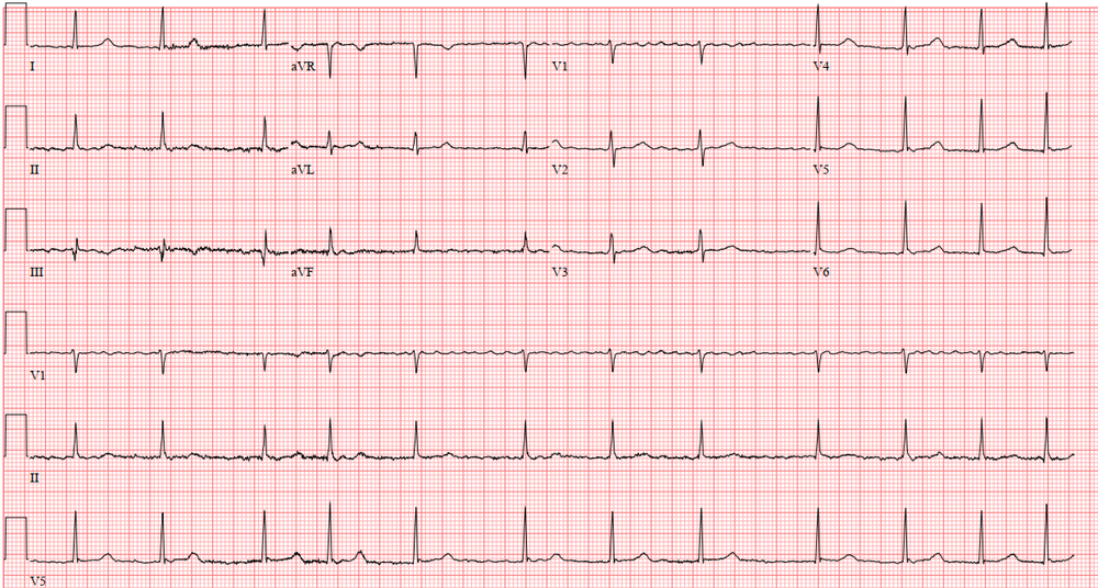 Atrial Fibrillation (AF) — When the Beat Drops: A Resident's Guide to ...
